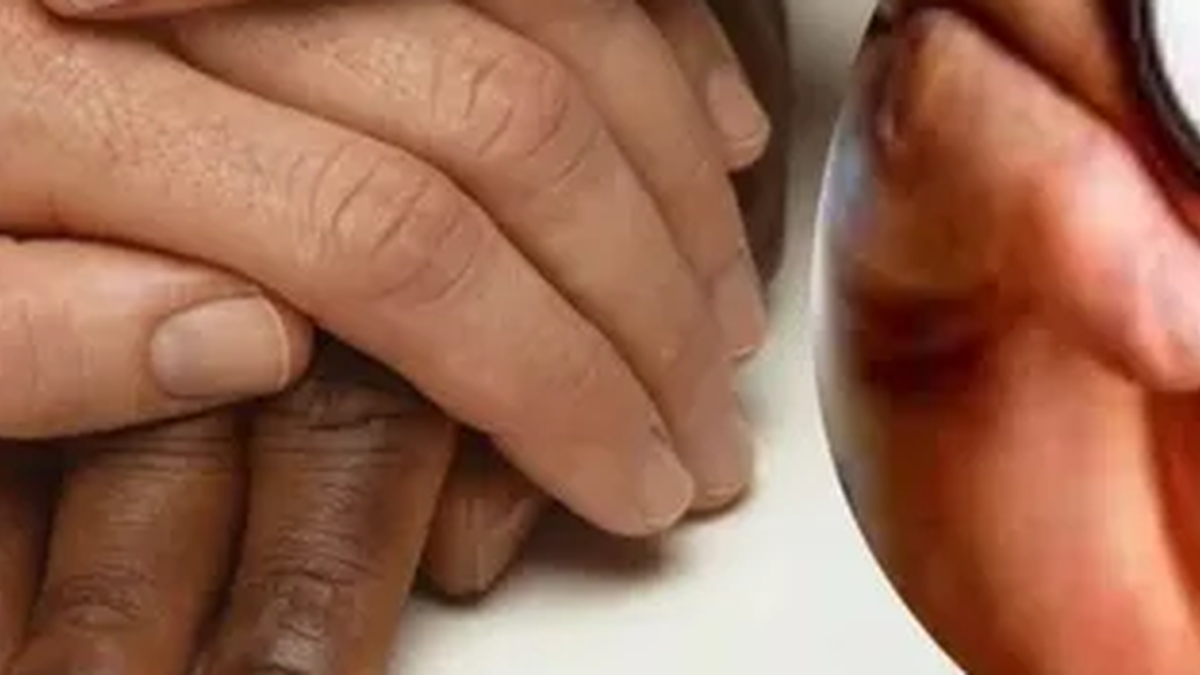 झारखंड में बच्चों के बीच कुष्ठ के मामलों पर स्वास्थ्य रिपोर्ट का सांकेतिक चित्र